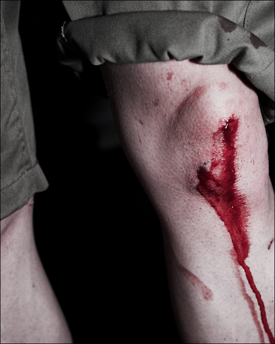 Knieverletzung mit Blut